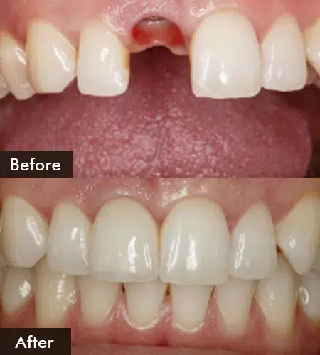 dental implants replacement in joplin