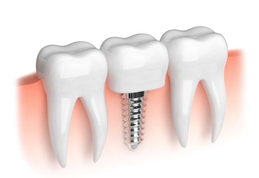 Dental Implant Procedure What to Expect