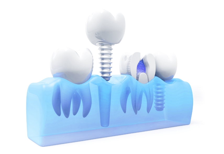 How To Care For Your Teeth At Home After Dental Implant Surgery