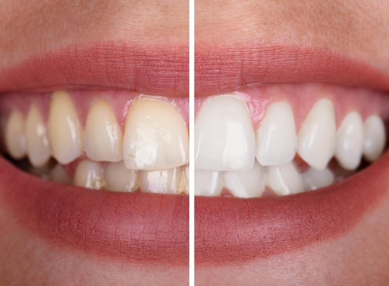 Risks And Benefits Of Teeth Whitening