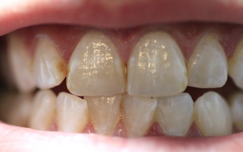 discoloration and teeth stains causes and treatment