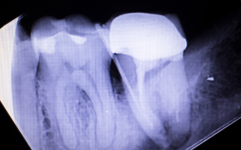vital signs of root canal infection to take seriously