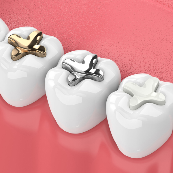 dental fillings in joplin