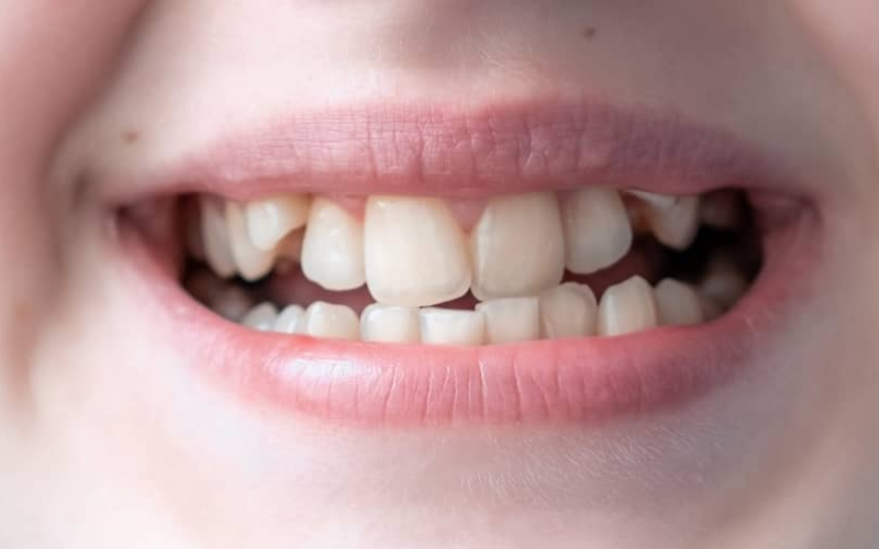 Can Cosmetic Dentist Fix Crooked Teeth