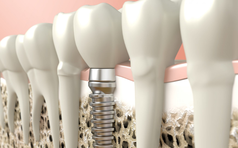 How To Floss Dental Implants